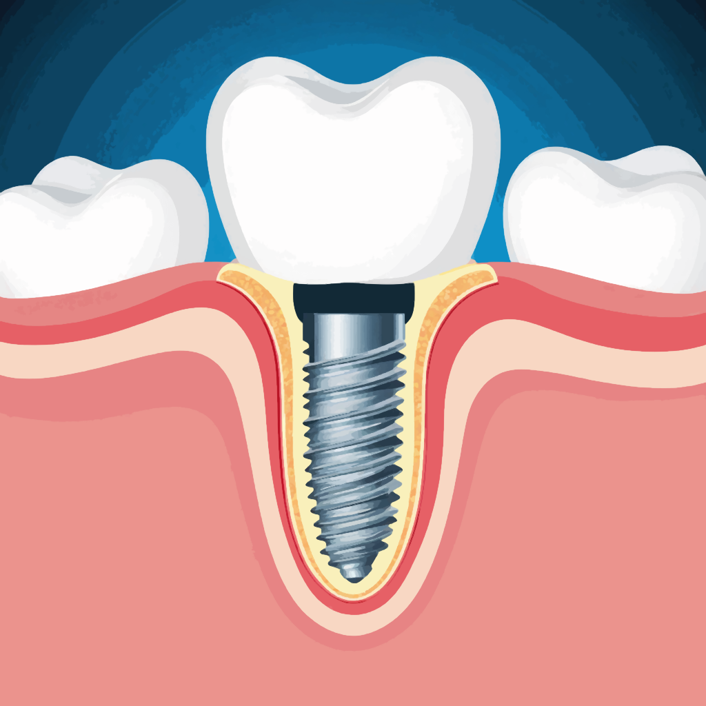 Изображение импланта