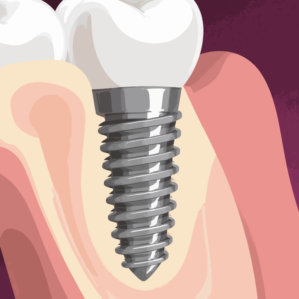 Изображение нормального импланта